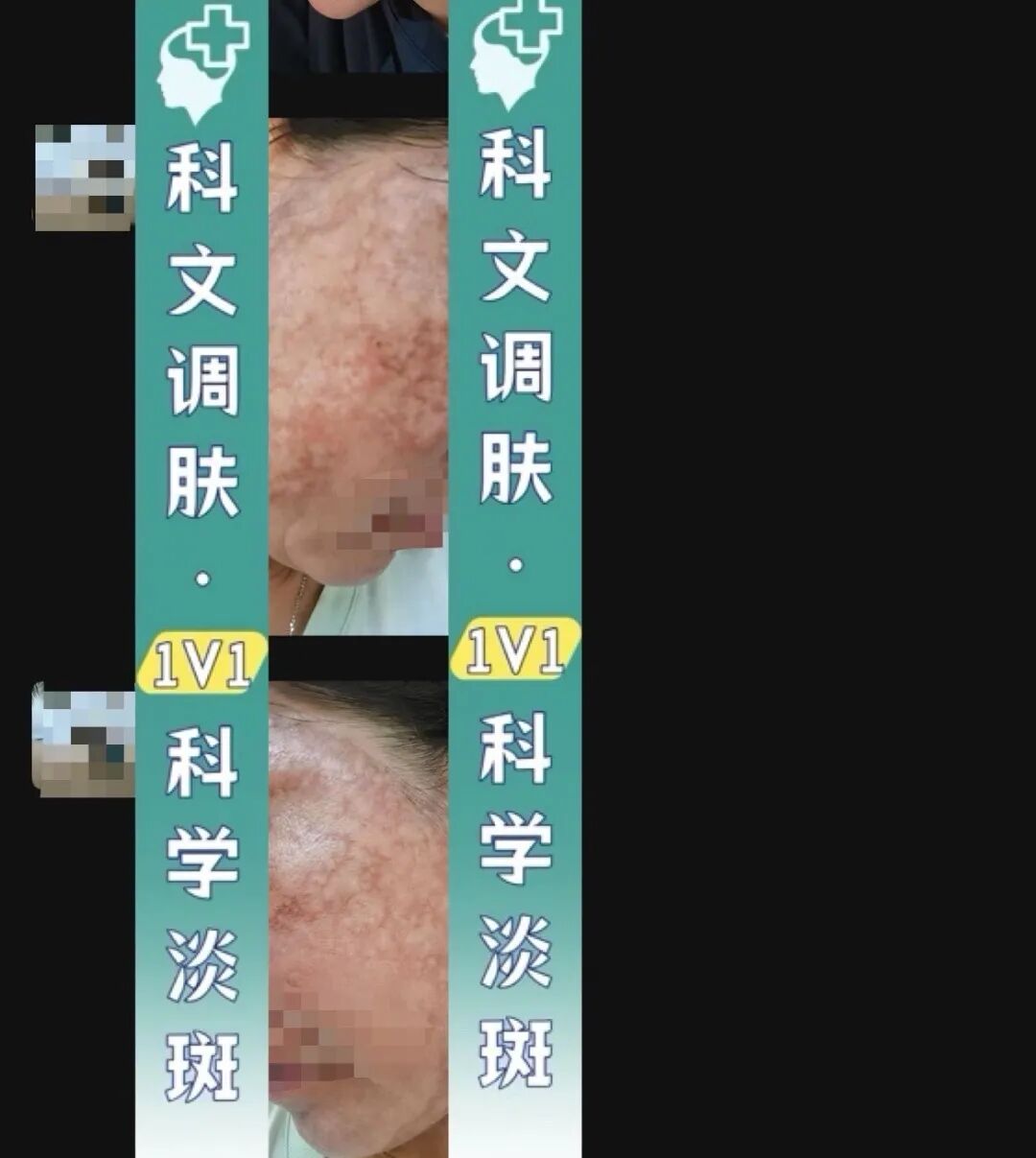 整张脸又红又肿，密密麻麻一片