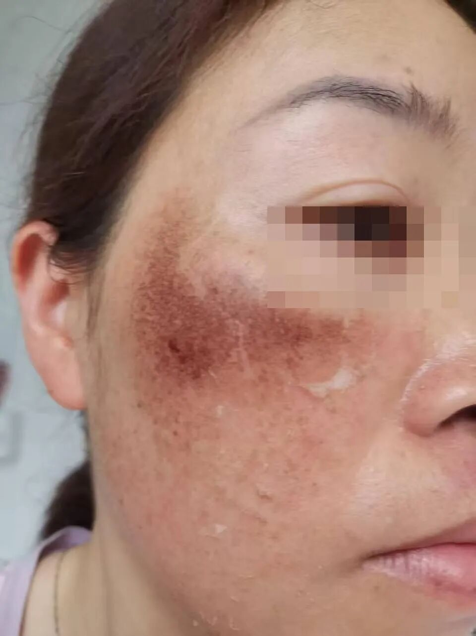 买了所谓排黑液后脱皮中，颧骨大片深红发黑