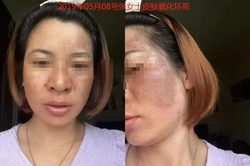 骗子发来的恐吓图，不继续用产品就会皮肤氧化坏死
