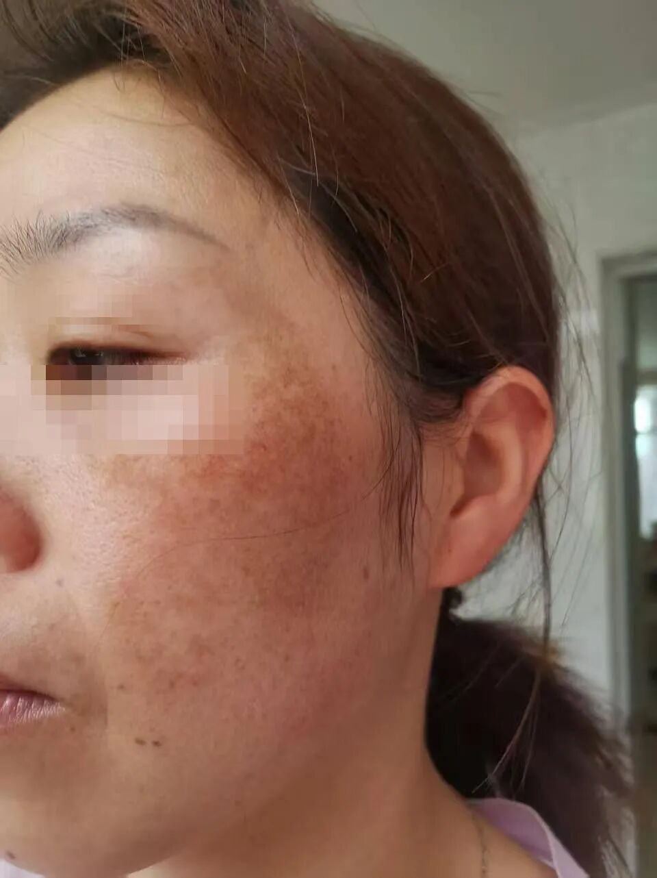 我以为我的脸要毁了——4个月后，她说你这效果这么棒