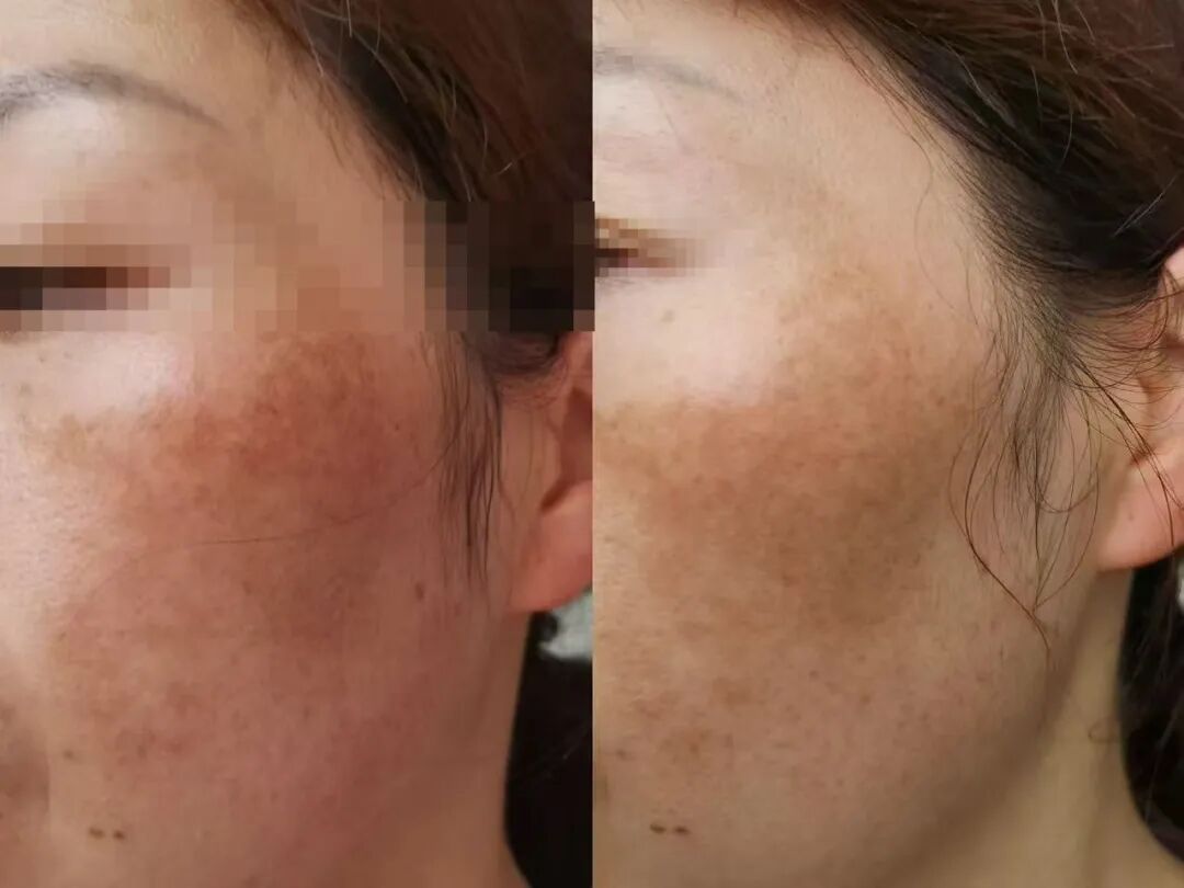 真 调肤约2个月调理过程对比：左调肤前 右调肤后