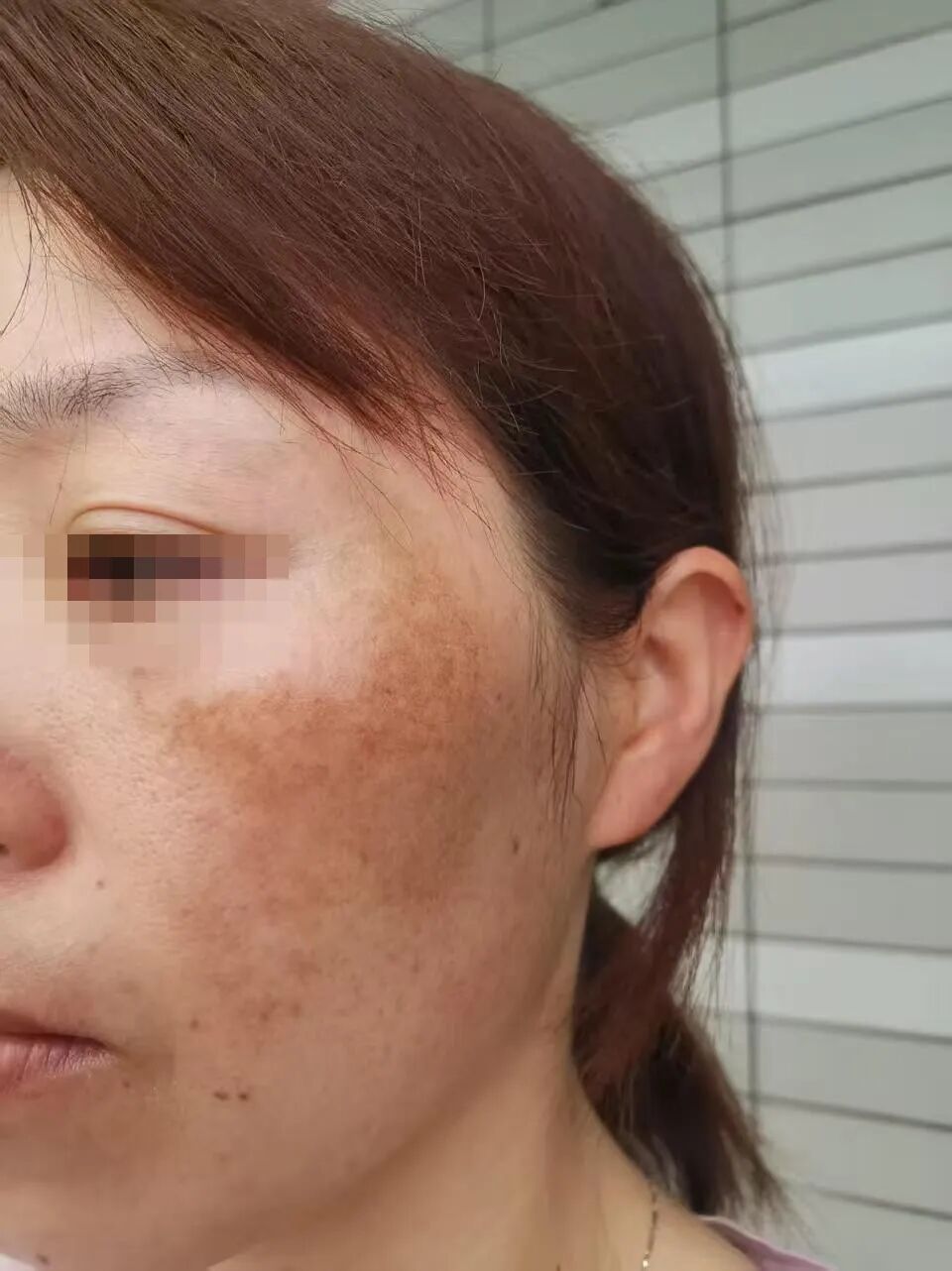 真 调肤1个月时的皮肤状态