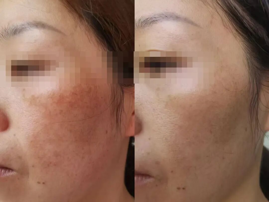真 调肤约3个月调理过程对比：左调肤前 右调肤后